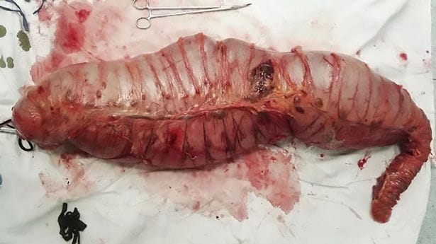 doctors remove 30 inches of china man’s bowel 