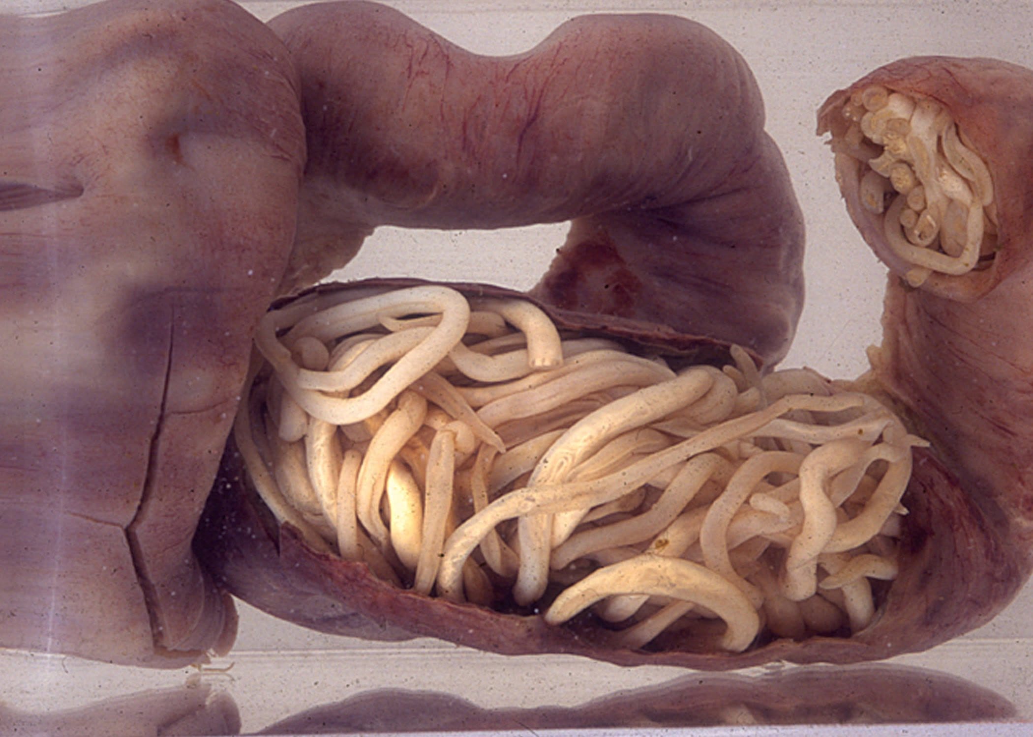 doctors remove 30 inches of china man’s bowel 