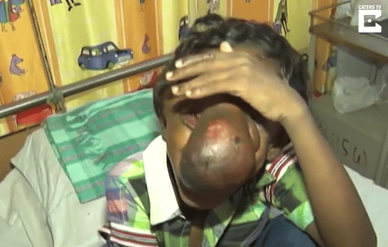 indian boy 9  has frontonasal encephalocele trunk like nose