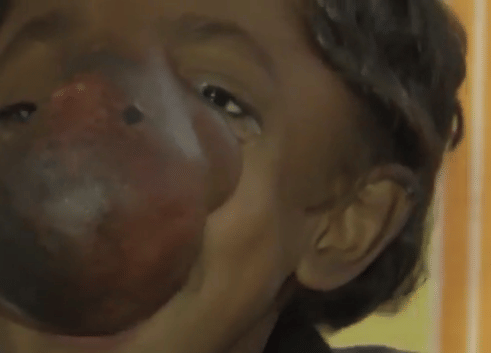 indian boy 9  has frontonasal encephalocele trunk like nose
