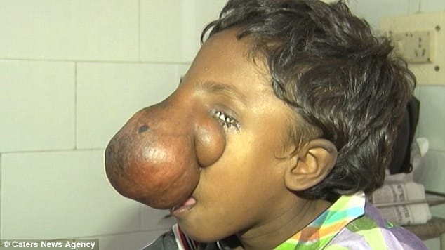 indian boy 9  has frontonasal encephalocele trunk like nose