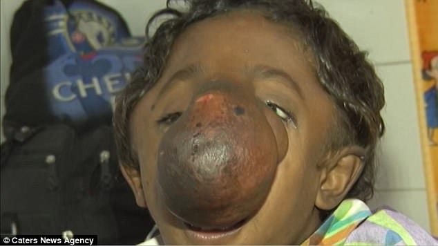 indian boy 9  has frontonasal encephalocele trunk like nose