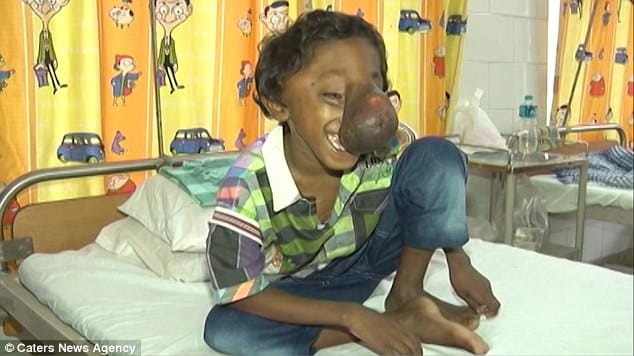 indian boy 9  has frontonasal encephalocele trunk like nose