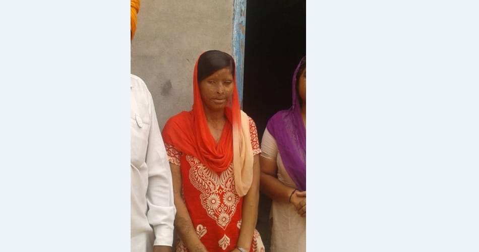 acid attack victim rajwant kaur, Ludhiana acid attack