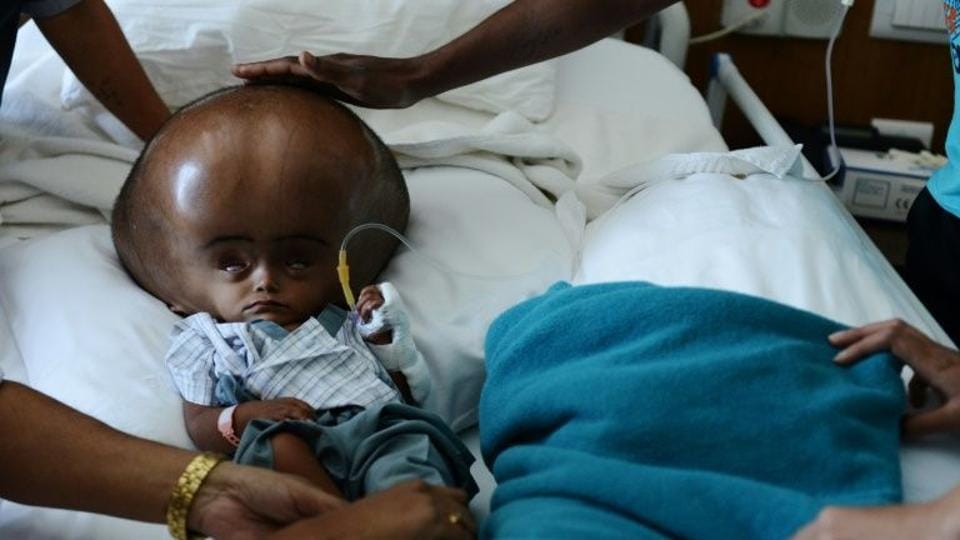 Tripura girl, whose head swelled to over three times its normal size, dies