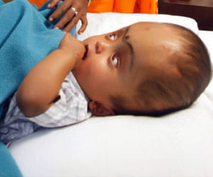 Tripura girl, whose head swelled to over three times its normal size, dies