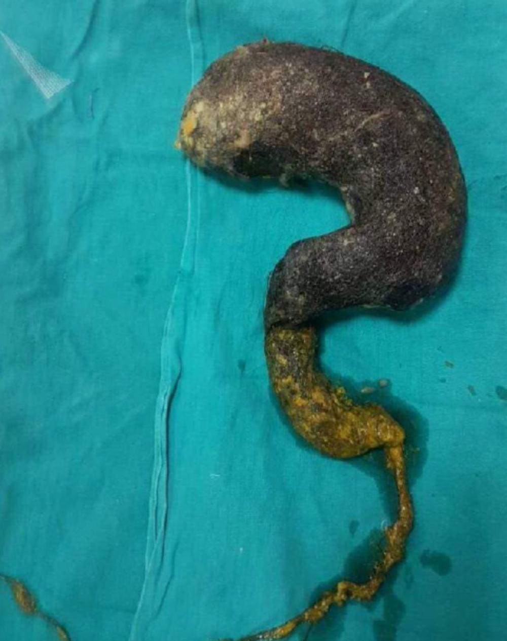 doctors found hairs in girl stomach during operation in dehradun