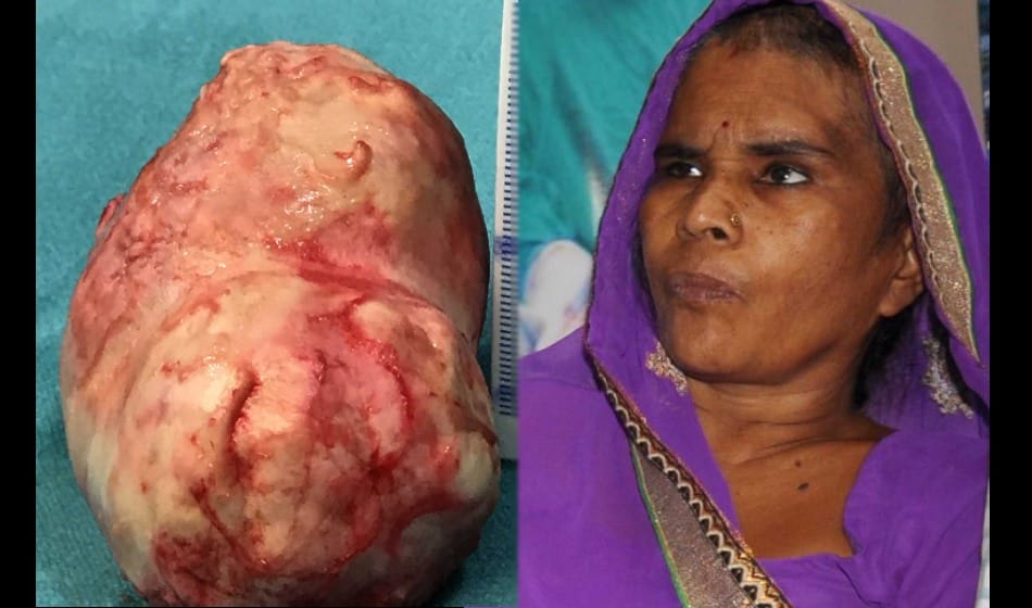  doctor operate 200 gram tumor from old lady brain in delhi 