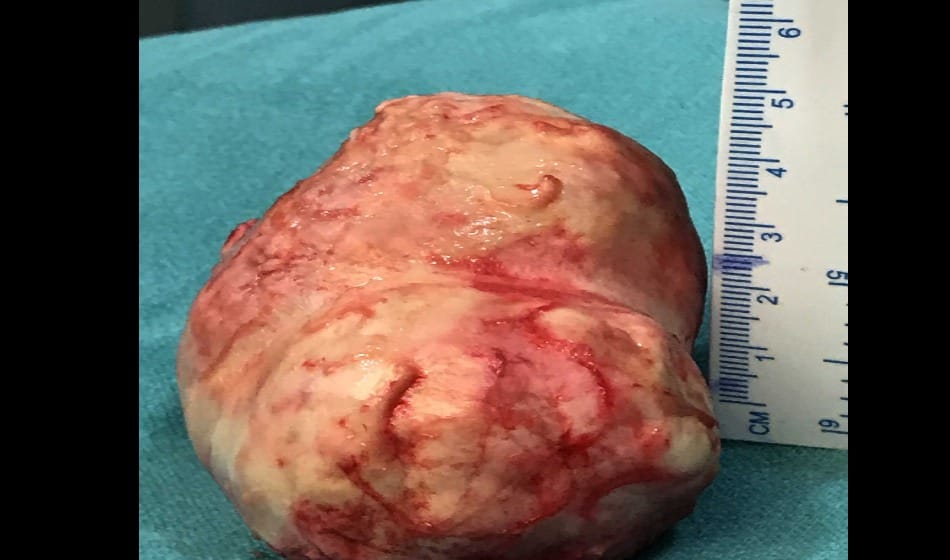  doctor operate 200 gram tumor from old lady brain in delhi 