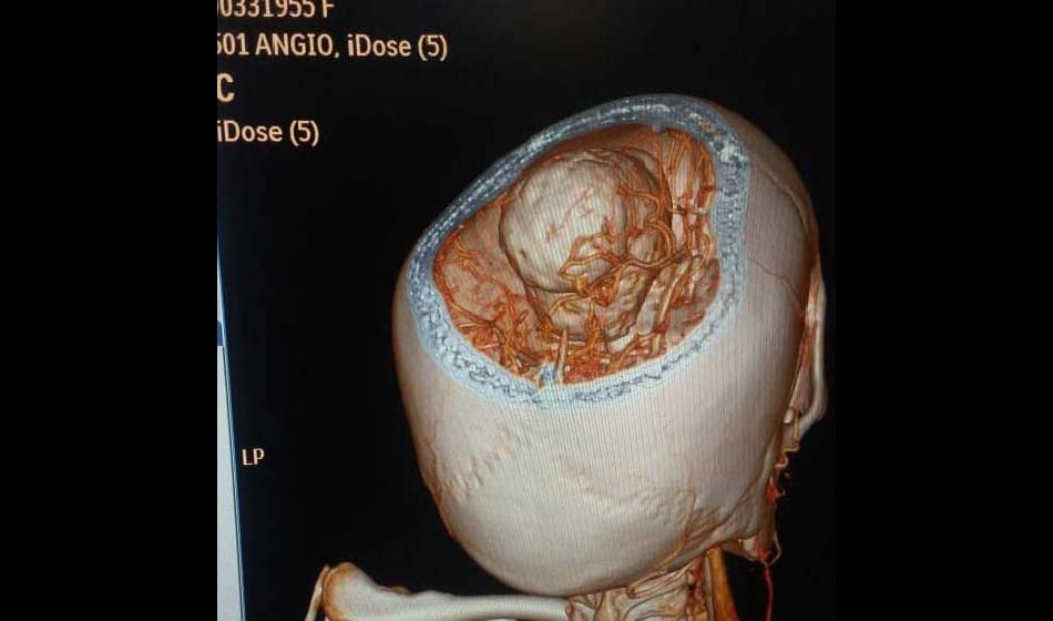  doctor operate 200 gram tumor from old lady brain in delhi 
