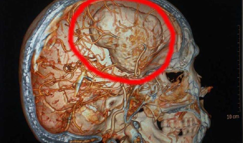  doctor operate 200 gram tumor from old lady brain in delhi 