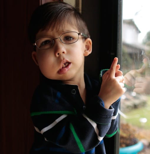 this three year old kid गे suffering from rare cloves disease 