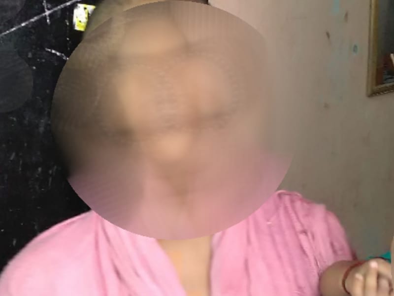 A woman tortured for dowary in Lucknow.
