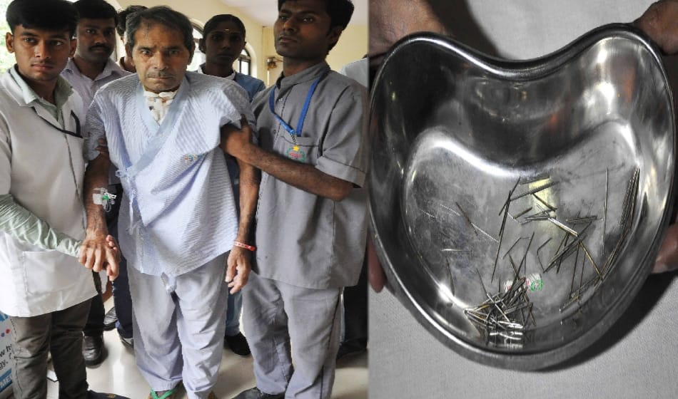 doctors found more than 150 pins and Needle from 56 years man