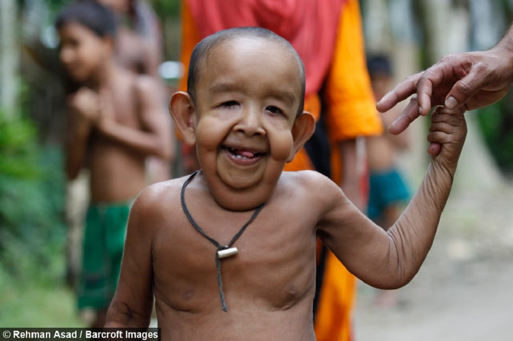 This is why four year old toddler looks like elderly man