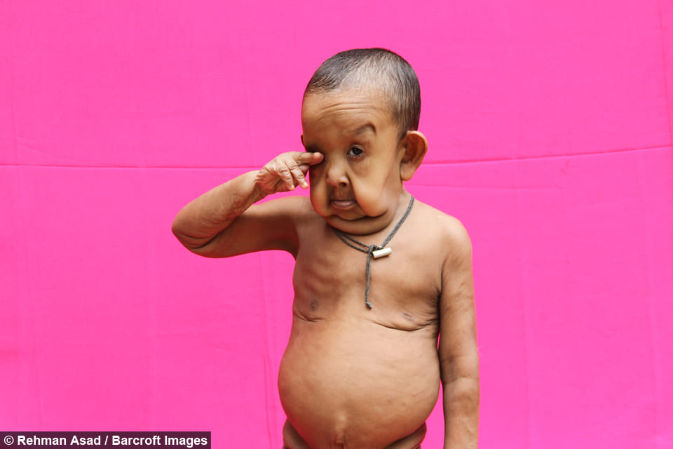 This is why four year old toddler looks like elderly man