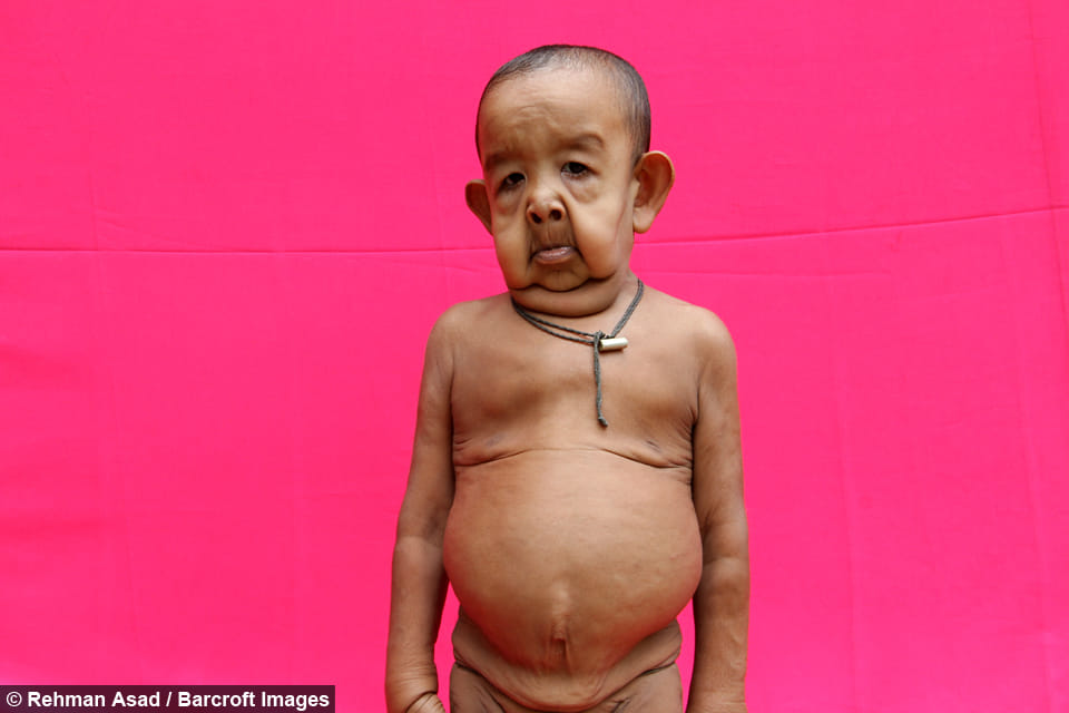 This is why four year old toddler looks like elderly man