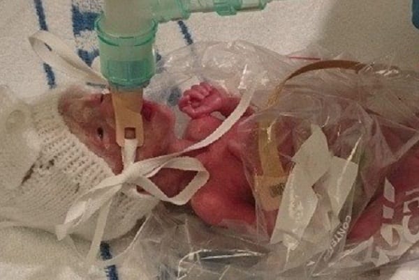 Premature baby saved after doctors put her in plastic bag