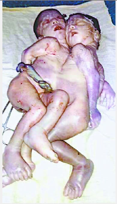 Female gave birth to conjoined twins