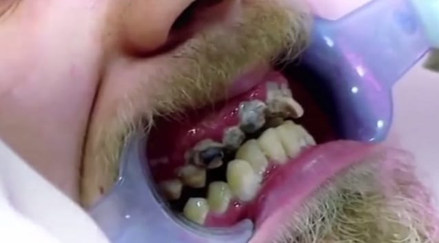 Guy confess he did not brush his teeth for 20 years