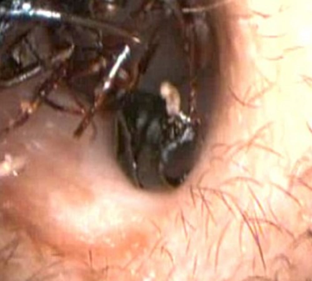 Indian girl has thousand of giants inside her ear 
