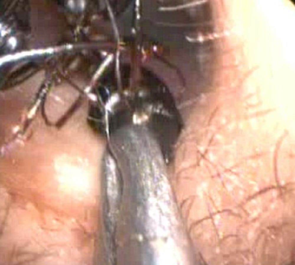 Indian girl has thousand of giants inside her ear 