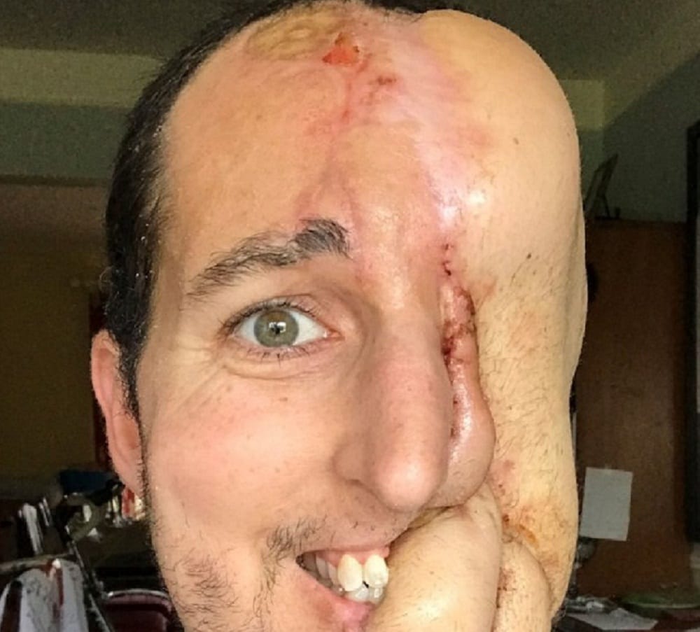 Michigan man lost half face to Synovial Sarcoma doctors built his face with legs