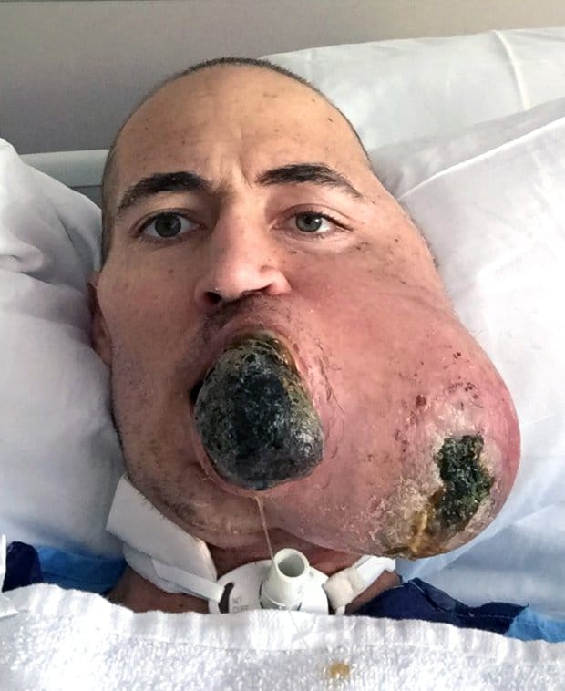Michigan man lost half face to Synovial Sarcoma doctors built his face with legs