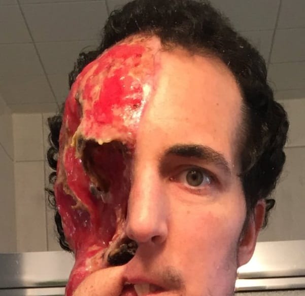Michigan man lost half face to Synovial Sarcoma doctors built his face with legs