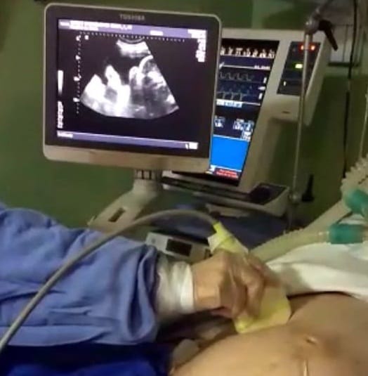 Brain dead women kept alive for 4 months gave birth   to twins in Brazil