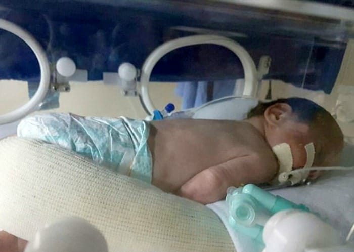 Brain dead women kept alive for 4 months gave birth   to twins in Brazil