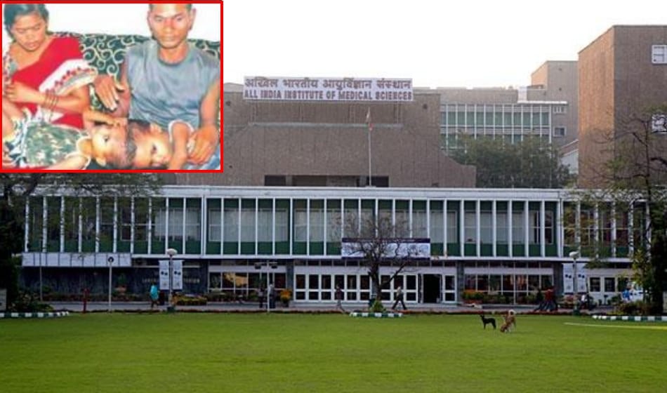 aiims will perform surgery of twins children whose head is attached 