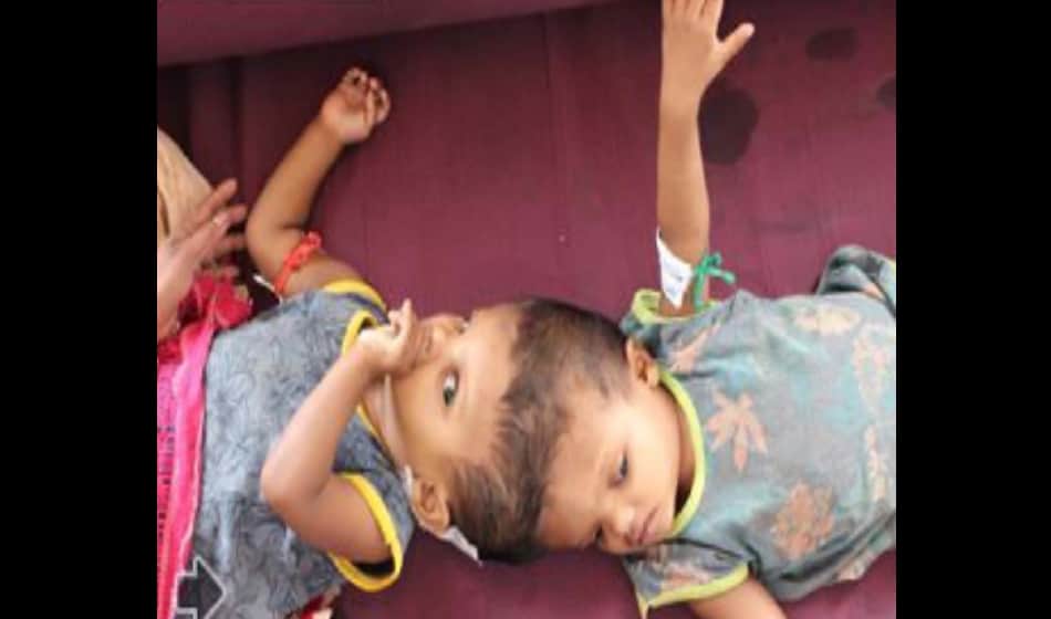  Odisha conjoined twins reached to AIIMS Delhi for separation surgery