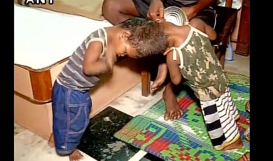  Odisha conjoined twins reached to AIIMS Delhi for separation surgery