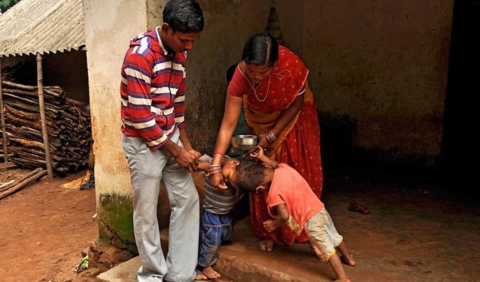  Odisha conjoined twins reached to AIIMS Delhi for separation surgery