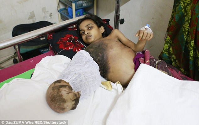 12 year bangladeshi girl battling with 'tree man' disease 