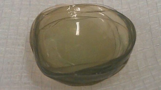  Age 67 and 'lost' 27 contact lenses in the eyes