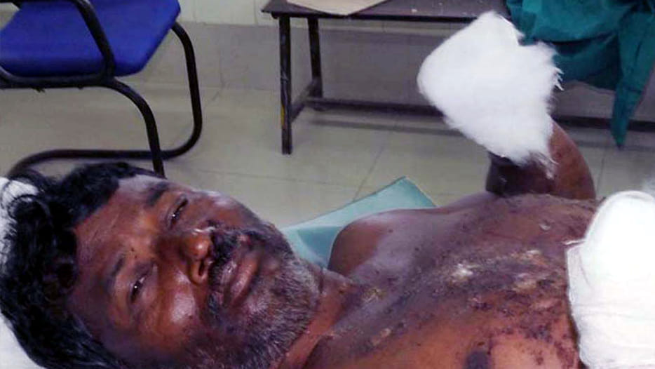 Bomb blast both palms damaged