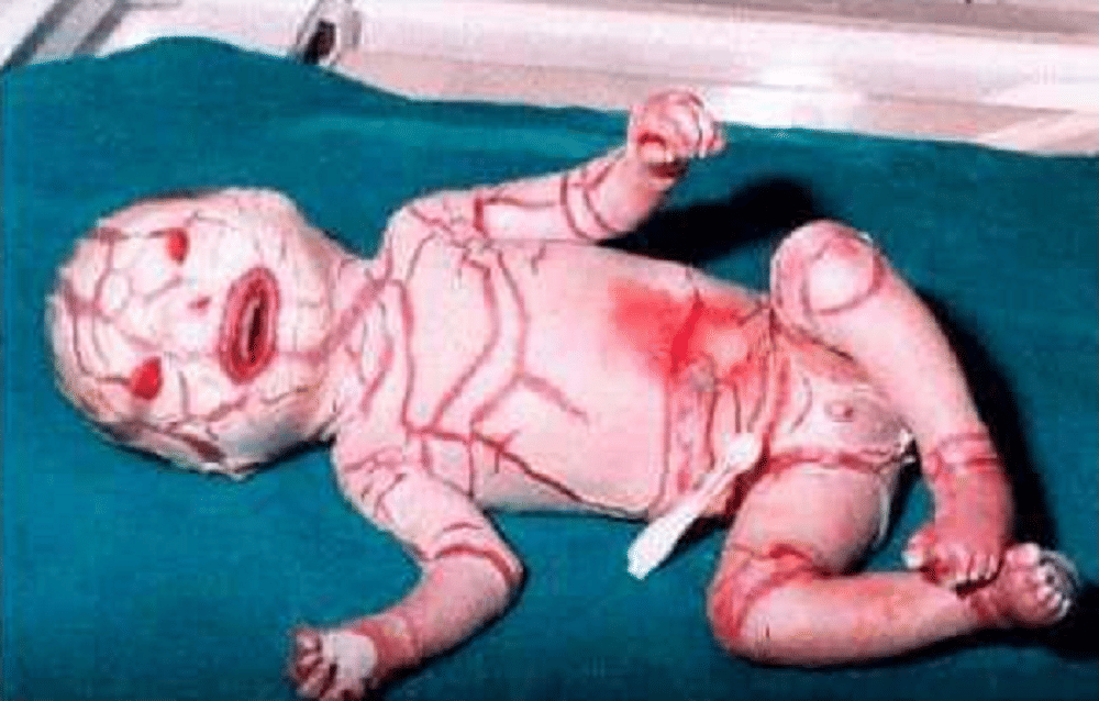 Harlequin-Type Ichthyosis is rare genetic disorder found in newly born babies