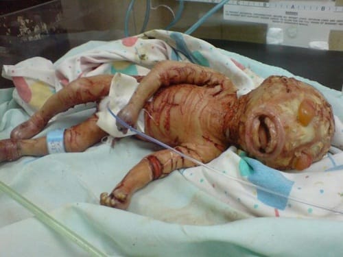 Harlequin-Type Ichthyosis is rare genetic disorder found in newly born babies