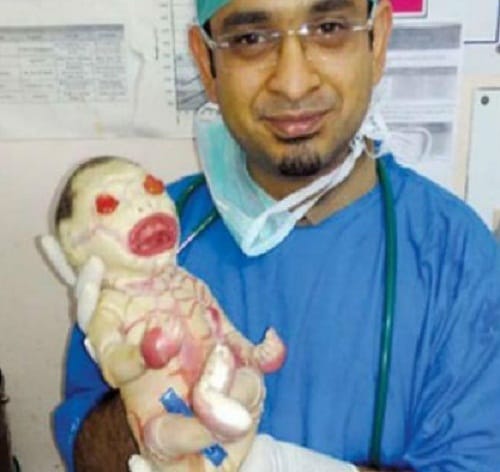 Harlequin-Type Ichthyosis is rare genetic disorder found in newly born babies