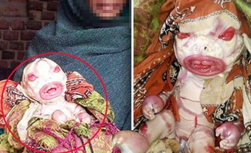 Harlequin-Type Ichthyosis is rare genetic disorder found in newly born babies