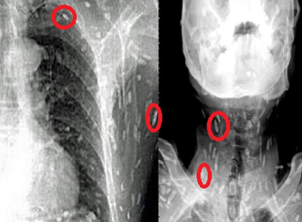 hundreds of tapeworms found inside man body fond of   eating raw fish