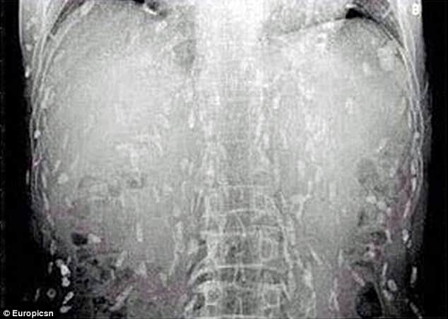 hundreds of tapeworms found inside man body fond of   eating raw fish