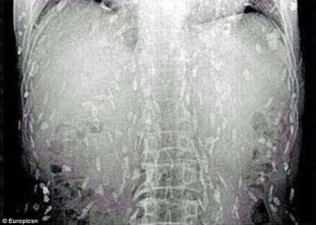 hundreds of tapeworms found inside man body fond of   eating raw fish