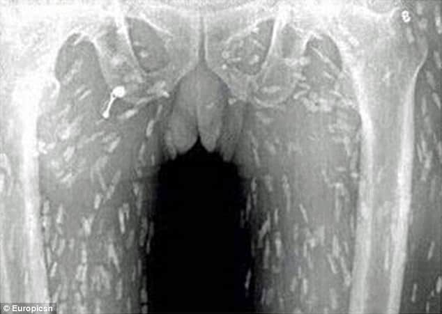 hundreds of tapeworms found inside man body fond of   eating raw fish