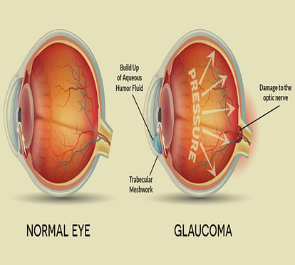 Glaucoma patients increasing rapidly in Gorakhpur