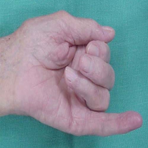 know about people, who have this type of finger