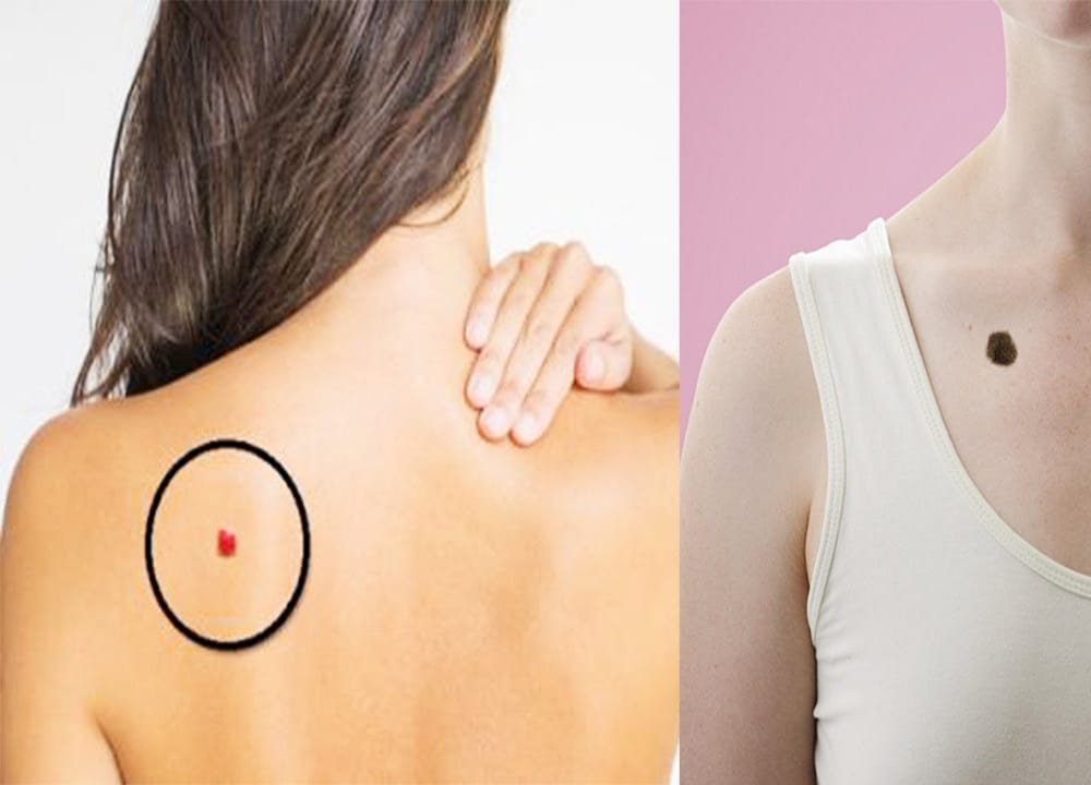 these mole palmistry sign makes you rich person