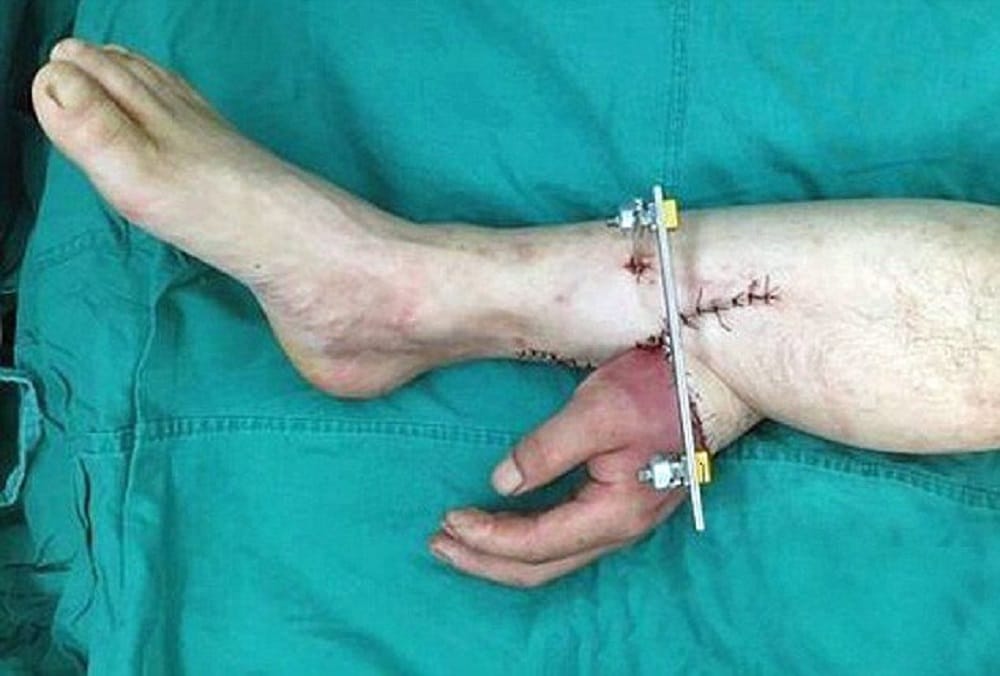 Man lost hands in accident doctor grafted it on leg